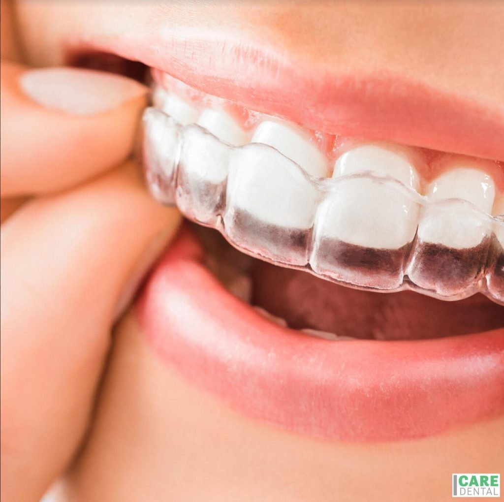 ???? Care ORTHO now offers Clear Aligners and traditional braces. Because getting straightened isn’t just for hair. ????????‍♀️ Show your teeth some LOVE by calling 778-484-CALM (2256) to book a complimentary ortho consultation today. At Care Ortho, beauty and function align.