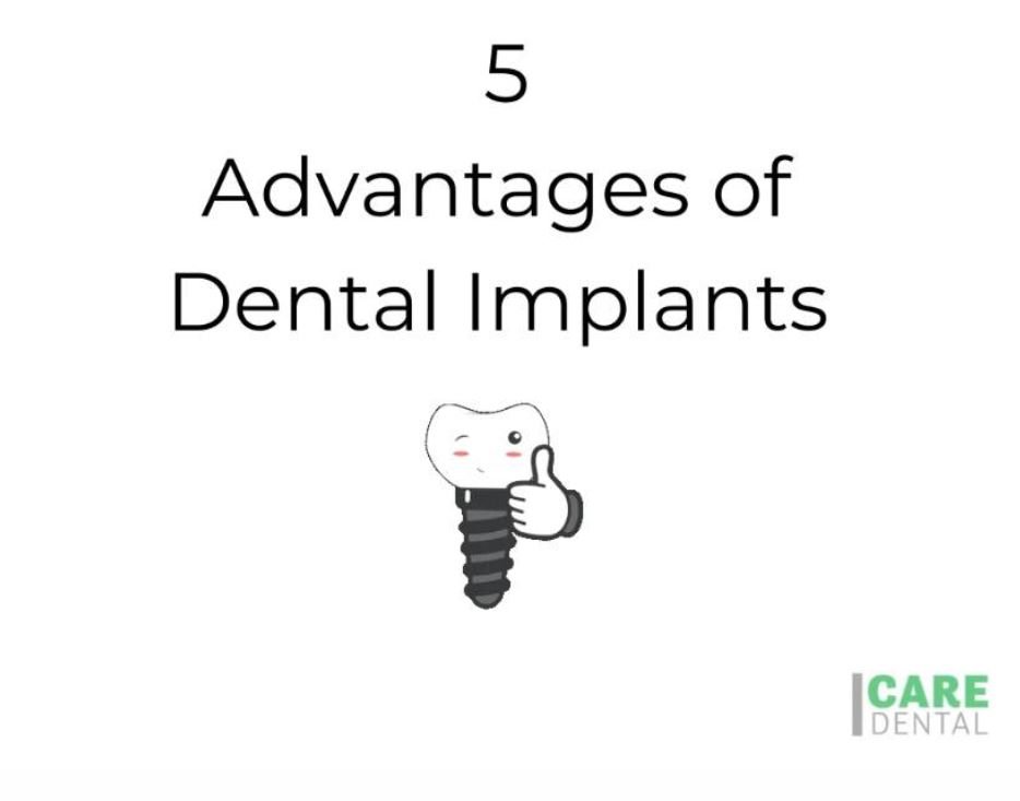 5 Advantages of Dental Implants Beauty. Cosmetically, it is difficult to visually identify an implant next to natural teeth. Smart. Implants stop adjacent teeth from shifting or needing to be "prepped" for a bridge. Strength. Implants prevent jawbone loss and changes in facial shape by mimicking the bone growth stimulation of a natural tooth. Longevity. A dental implant can last up to 30+ years! Cost Efficient. Although there is an initial investment, dental implants are typically a one-time investment and less expensive over time compared to other options. ???? Dental implants can provide a beautiful & healthy option to address missing teeth. A dental implant consists of three parts, which begin with freezing the area and inserting a titanium screw into the gum and jawbone to serve as fresh tooth “roots,” similar to how a normal tooth has a base, pulp, or dentin, and crown. An abutment or connector is placed atop the titanium screw until the jawbone and gums have healed and the titanium root has been accepted. The final part, the new tooth crown, is installed. As a result, you’ll have a permanent new tooth that’s as healthy as a normal tooth, allowing you to smile and chew without fear. ???? *Dental implants must be prescribed by your dentist as part of your individual treatment plan. Care Dental is currently accepting new patients. Call 778-484-CALM or visit www.caredental.ca today. We always look forward to hearing from you. ????????‍♀️ #whosyourdentist Dr. Dan Kobi, General Dentist & Principal Dentist Associates: Dr. Chad Fletcher, General Dentist Dr. Danny Zare, General Dentist Dr. Justin Abbott, General Dentist Dr. Dionysius David, General Dentist Dr. Jack Gordon, General Dentist #acceptingnewpatients #dentalimplants #teethinaday #DentistKelowna #CareDentalKelowna #generaldentistry #cleanings #aesthetics #beautifulsmiles are #healthysmiles #dentistry #implants #braces #love that #caredentalsmile #invisalign #passionfordentistry #spa-inspired #okanagandentist #Kelowna #kelownalifestyle #thedentistyoulllookforwardtovisiting #welcometothecaredentalfamily #getmorebutdontpaymore