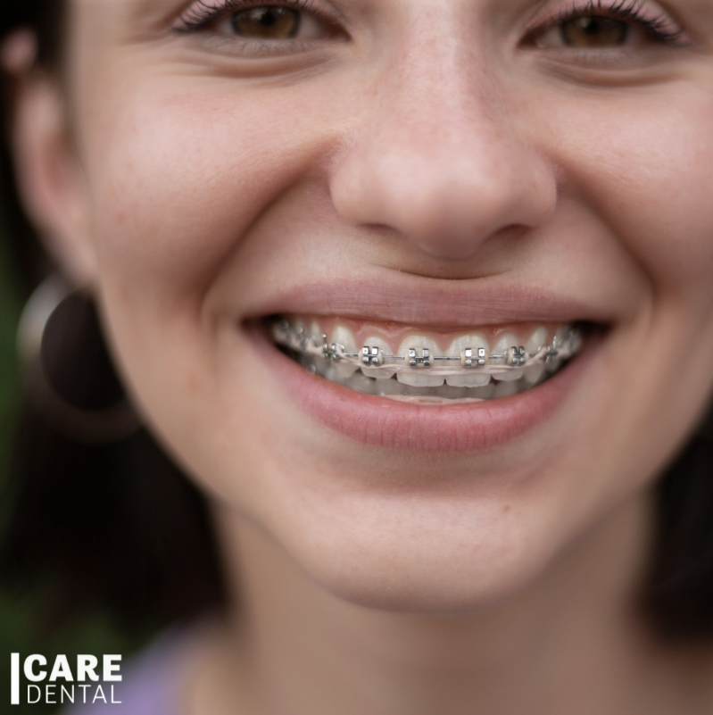 We provide traditional wire and bracket braces 😁 a proven method for achieving an aligned smile. Metal brackets attach to your teeth and are connected by wires that gently guide your teeth into their proper positions. They’re a great option for those who require more complex or precise tooth movement. Call us for a free ortho consult