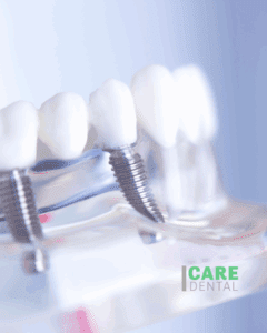 Care Dental Implants