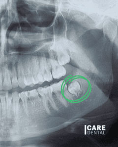 Care Dental Kelowna Wisdom Tooth Extractions